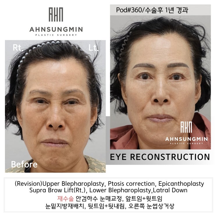  눈 재수술 과정 [성형외과 전문의 안성민]