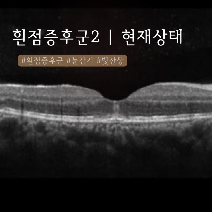  흰점증후군, 눈감기 2 | 자연치유 현재 상태
