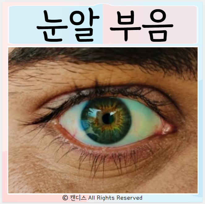  눈알부음 원인 알레르기 결막부종 치료 증상