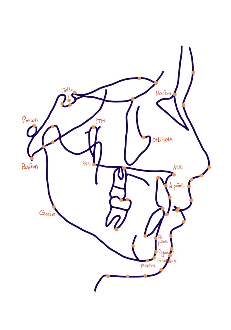  치아교정 측모(옆모습) x-ray 중요성 / Cephalometric bony landmark in orthodontics