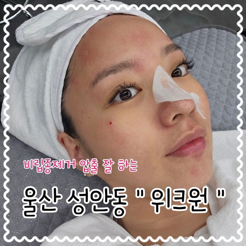 울산 성안동 비립종제거 압출 잘하는 위크원 베르도소 관리 찐 후기