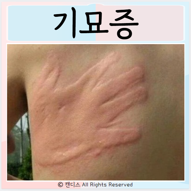 기묘증 원인 증상 관리와 치료방법은?