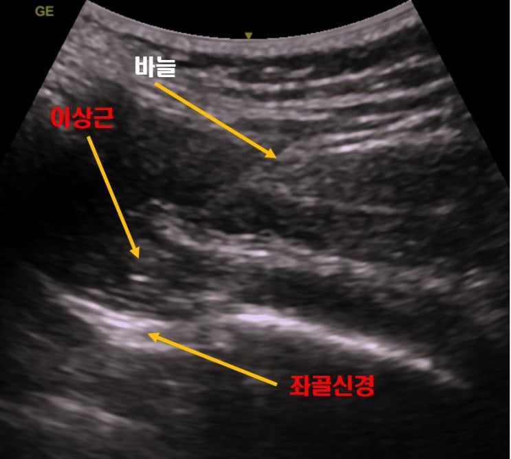  광주 이상근증후군, 엉덩이 허벅지 통증 종아리 저림?