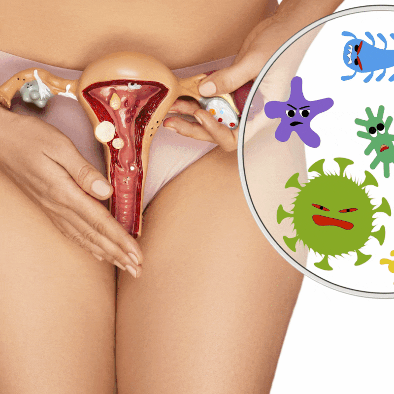 클라미디아 트라코마티스 질염, 총정리 (Chlamydia Trachomatis) 증상, 진단, 치료