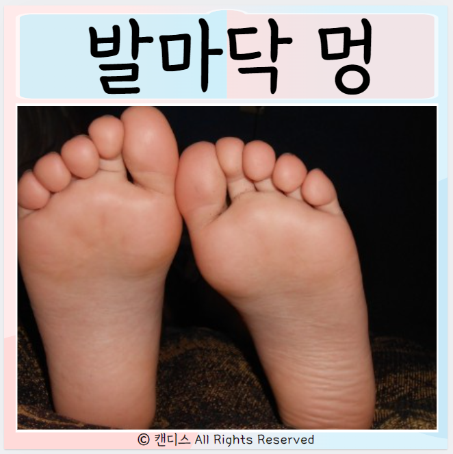  발마닥에 멍이 자주 드는 이유? 멍색깔 검은멍