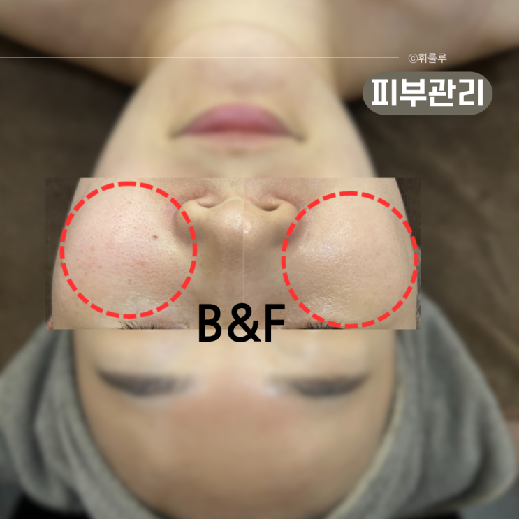  마산 피부관리 VVS무결점 프로그램 천지인에스테틱 모공관리