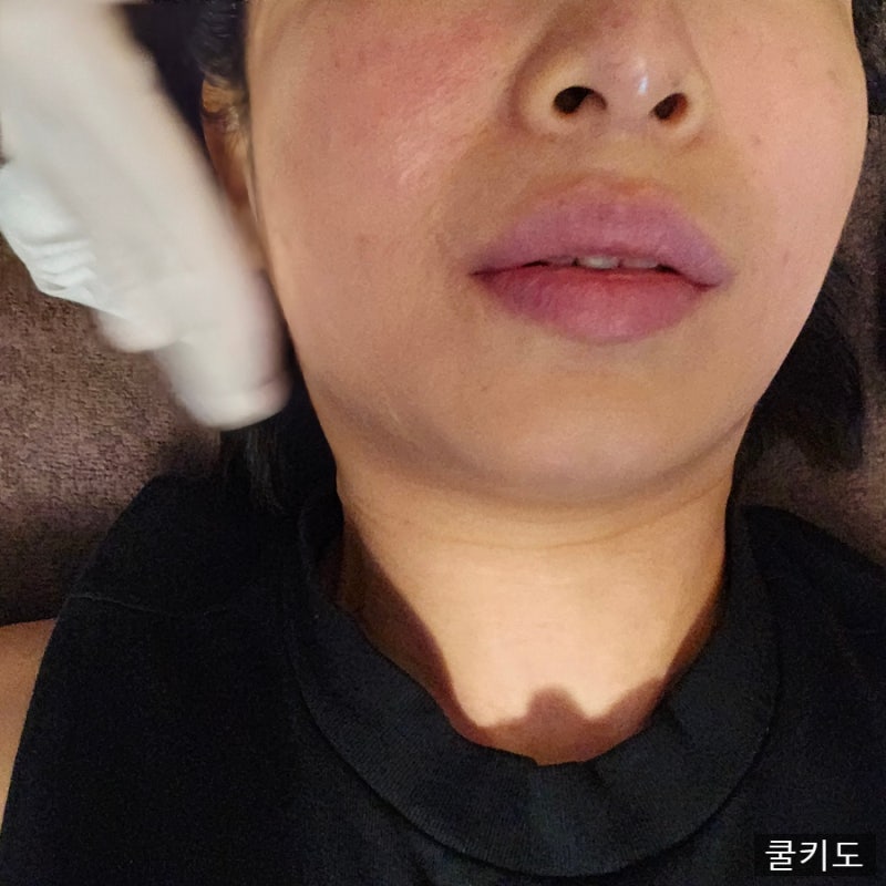 강남역 성형외과 스킨부스터 쥬베룩 후기! 잔주름 개선