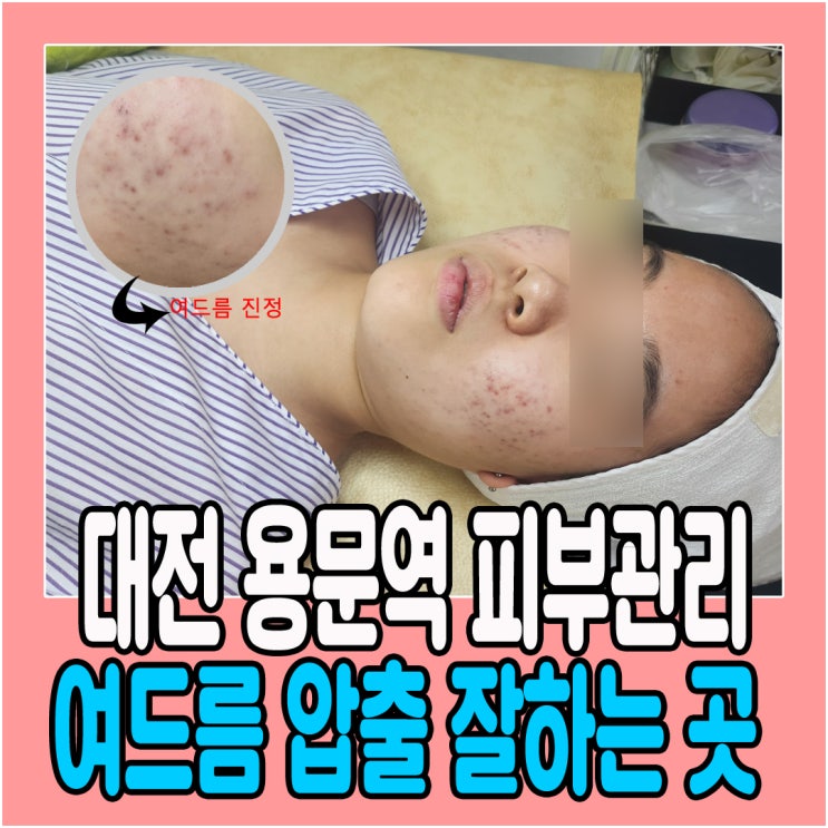  대전피부관리 여드름압출 잘하는곳 빔샵