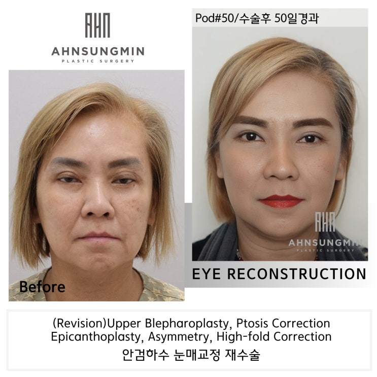  겹주름의 근본적인 원인, 눈 재수술 [성형외과 전문의 안성민]