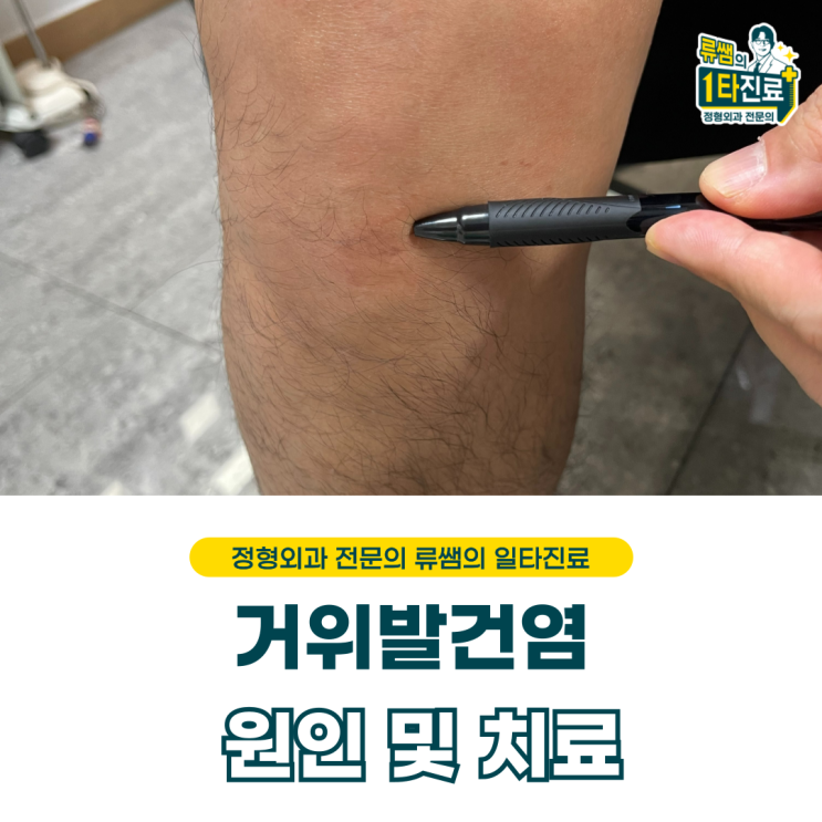  무릎 통증, 거위발건염 원인 및 치료(의사작성)
