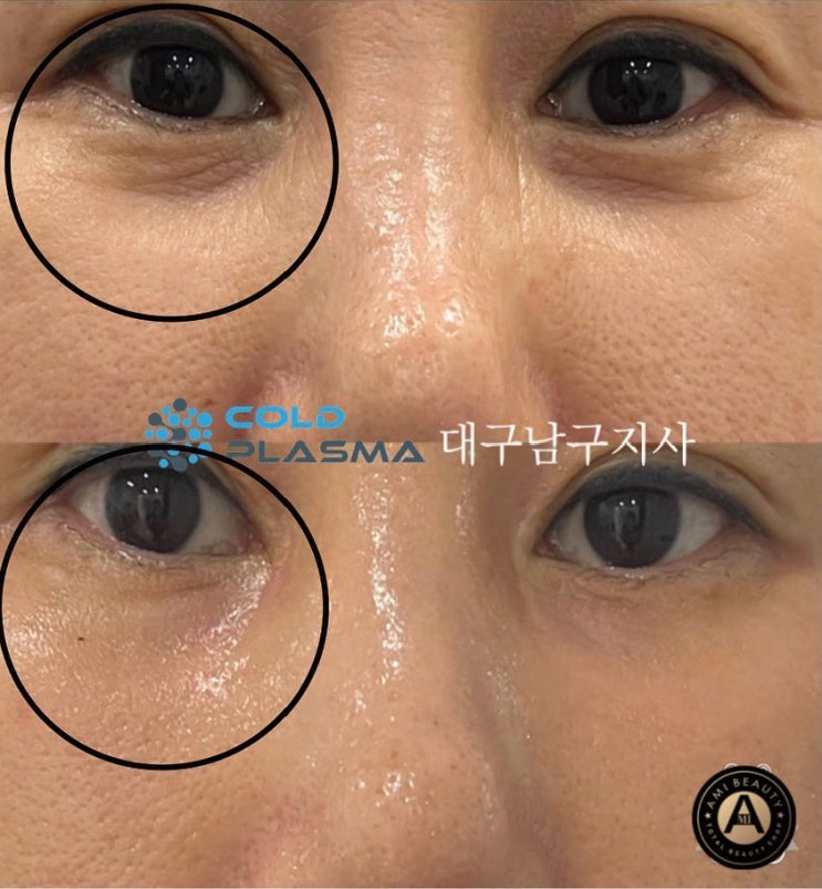  대구플라즈마교육 도 가능한 아미뷰티, 콜드플라즈마 시술로 눈밑꺼짐, 눈밑주름, 다크써클 개선이 가능한 이유