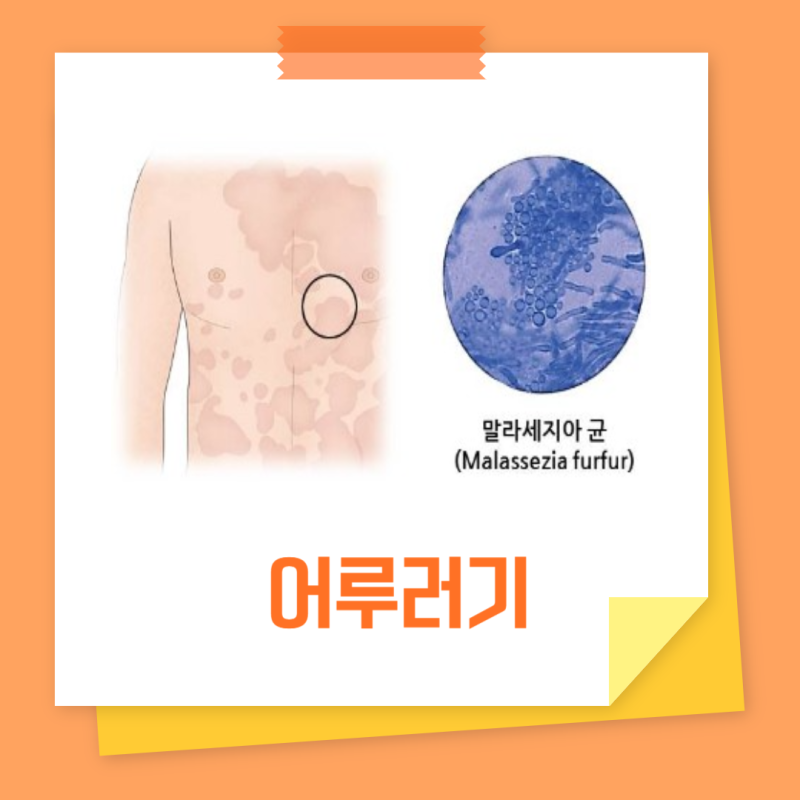 겨드랑이 어루러기 연고 원인 증상 전염
