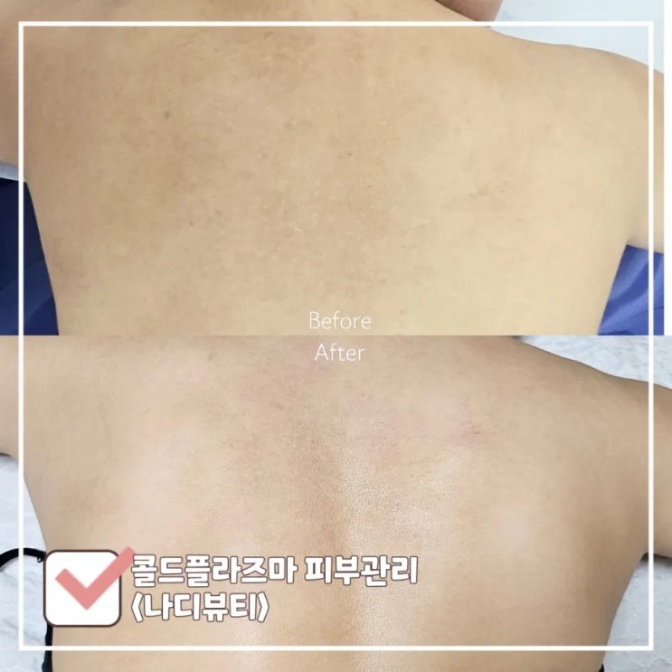  콜드플라즈마 1회차 리얼 후기 | 여드름·아토피 흉터 치료 전문 '나디뷰티'