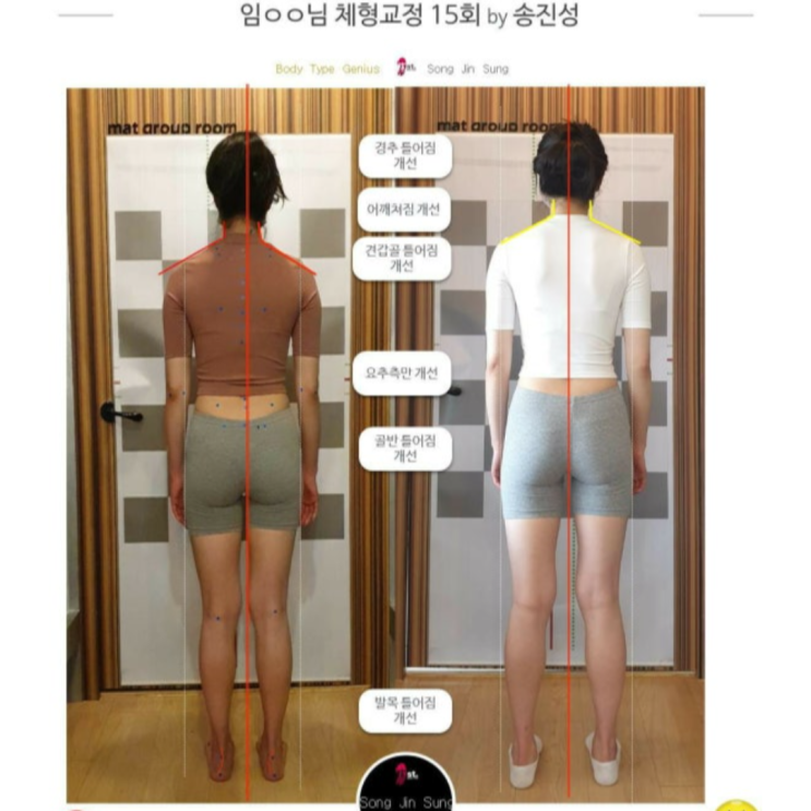  부산 사직동 LV체형분석운동센터 X자다리 교정 후기
