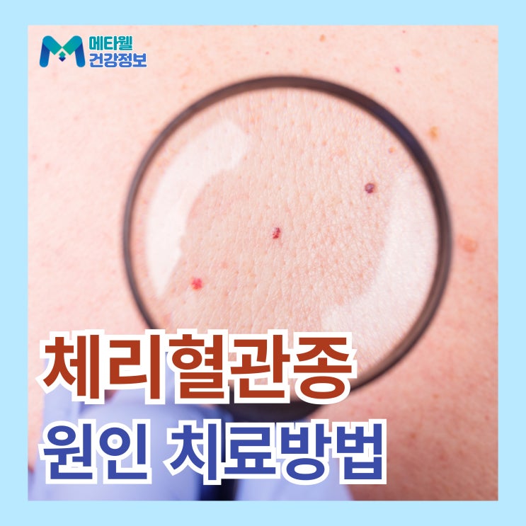  피부 붉은 반점이 늘어나는 체리 혈관종 대표적인 노화 증상? 치료방법 정리