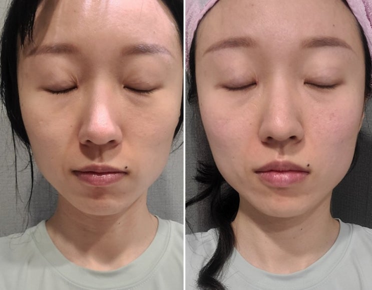  강남역 피부과에서 튠페이스 받은 후기 효과 부작용