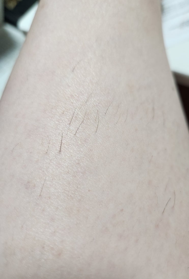  실킨제모, 겨드랑이 다리 레이저 제모 후기