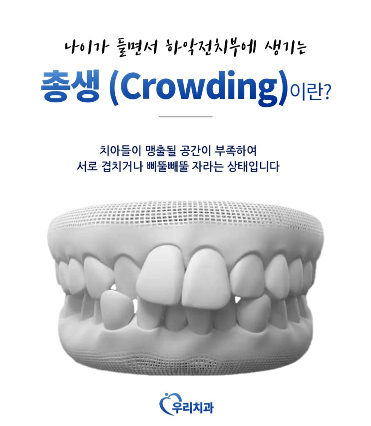  총생 나이들면 하악 전치부에 생기는 이유? #Crowding #교정