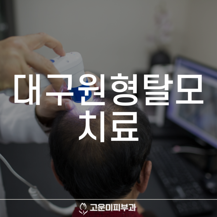  대구탈모치료 원형탈모 정확한 원인을 파악하고 조기에 치료해야 합니다