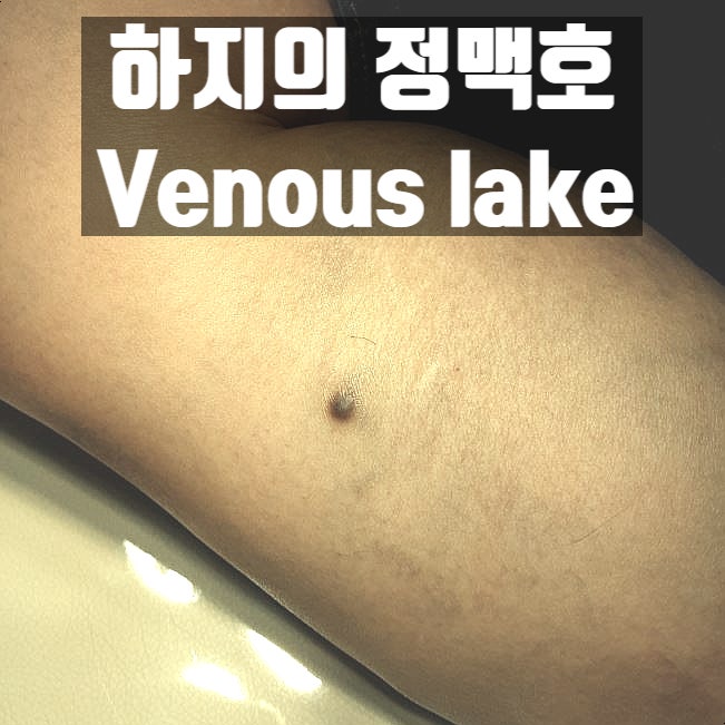  종아리에 발생한 검붉고 부드러운 결절 - 정맥호(Venous lake)