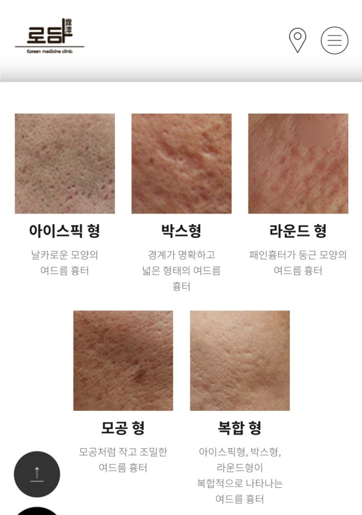 내돈내산 로담한의원 부산점 패인 흉터 치료 후기 내돈내산 로담한의원 부산점 패인 흉터 치료 후기