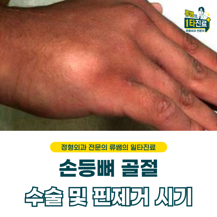 손등뼈 골절 수술 및 핀 제거 시기(의사작성)