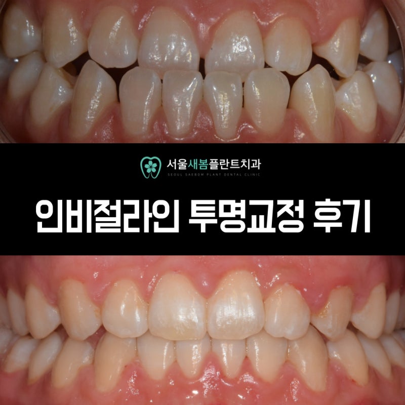 3급 부정교합, 인비절라인 교정 가능한가요?