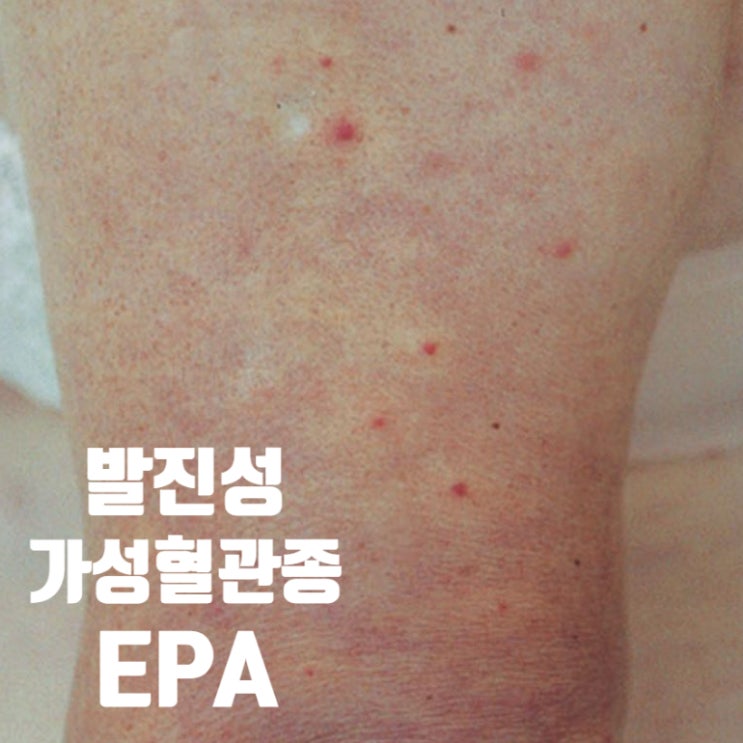  팔다리에 갑자기 빨간 점이 생겼어요, 발진성 가성혈관종 (Eruptive pseudoangiomatosis)
