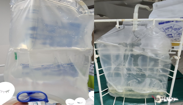 복막투석(Peritoneal Dialysis) 방법 그리고 복강을 통해 투석하는 복막투석 원리 및 간호 : 네이버 블로그