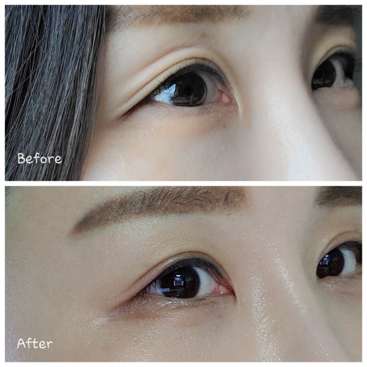  리아이필러 눈꺼풀필러로 눈위꺼짐 채웠던 솔직후기 (+통증, 가격, 부작용)