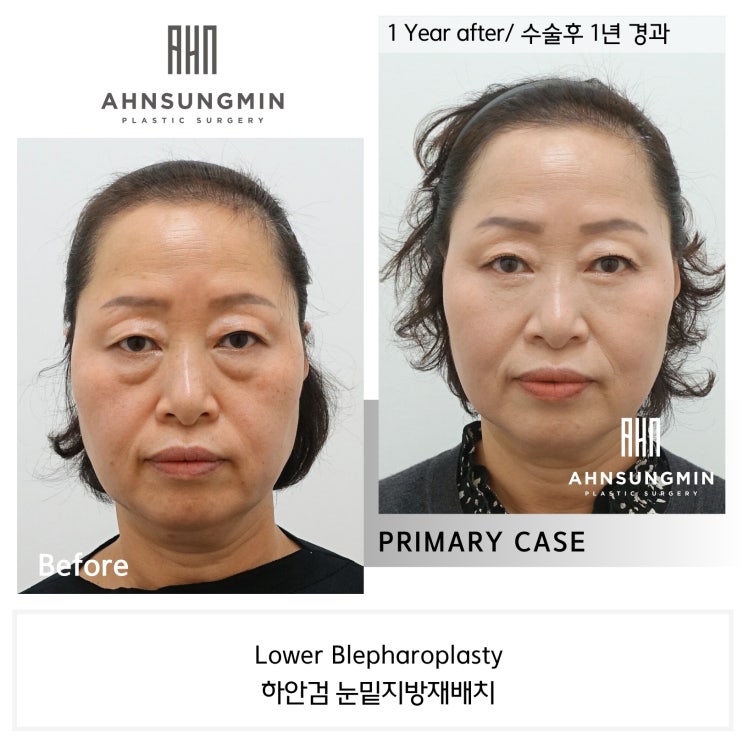  중년 눈 밑 지방 재배치 수술 후 1년 경과 [성형외과 전문의 안성민]