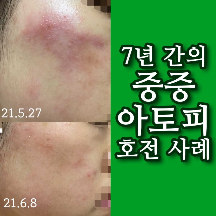  중증 난치성 아토피 환자의 증상 및 치료 사례 후기