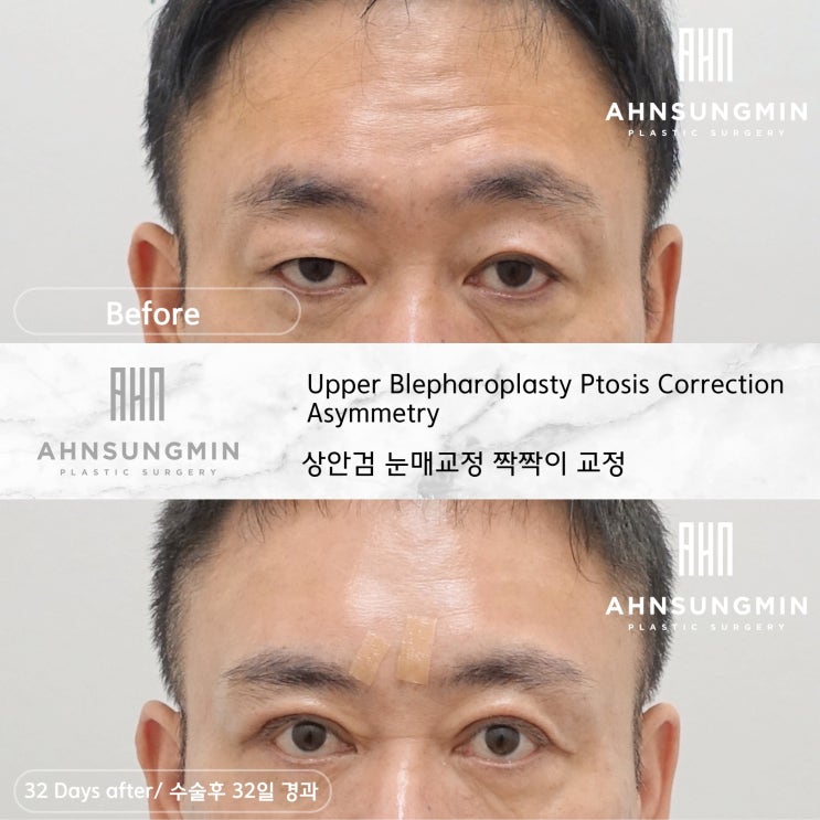  남자 짝짝이 쌍꺼풀 교정 후 32일 경과 [성형외과 전문의 안성민]