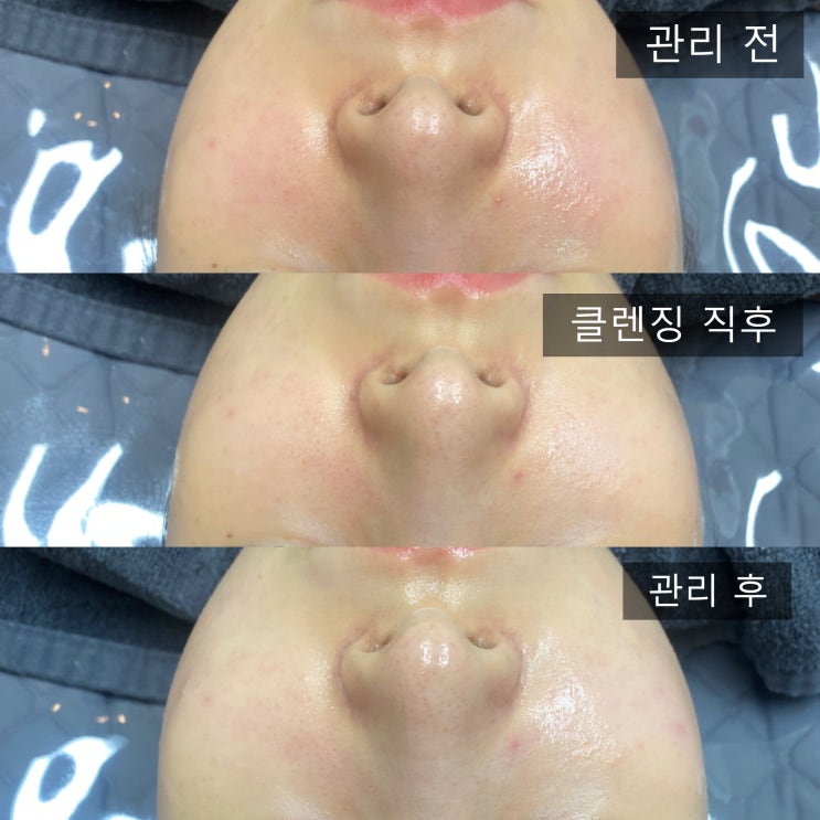  부천 신중동피부관리 빨간피부로 고민인 사례자
