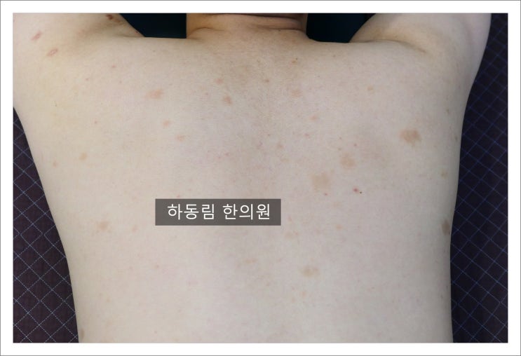  백비(건선)의 특징과 증상, 치료 후기 및 사례