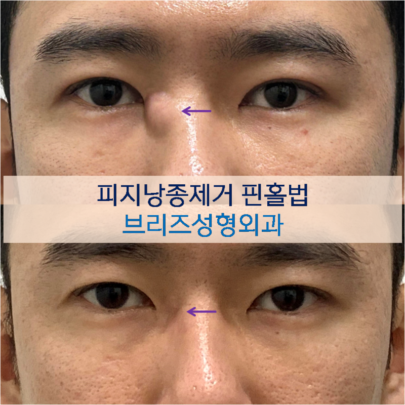 안산 피지낭종 성형외과, 핀홀법으로 제거한 염증성 낭종