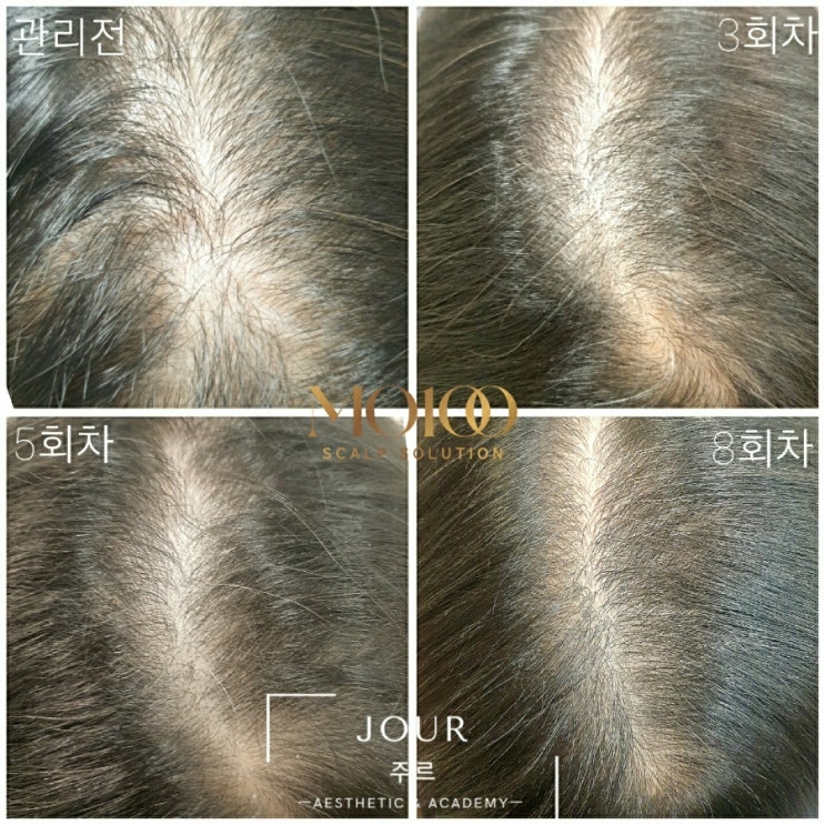 ◽부산 주르 에스테틱◽머리카락이 채워지는 모발 생장 관리