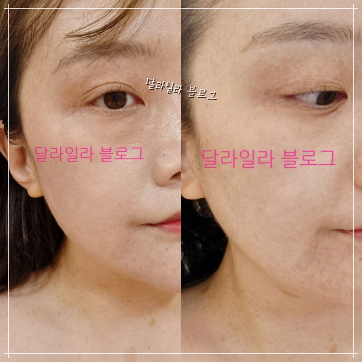  부천역윤곽관리추천 웰레스테틱부천역점에서 얼굴 라인 개선하기