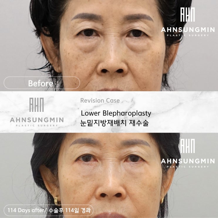 [하안검 재수술의 진실] 하안검도 재수술이 가능할까?