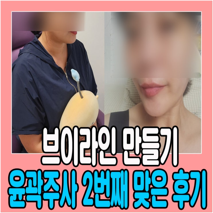  대전 윤곽주사로 브이라인만들기 2번째 맞은 후기