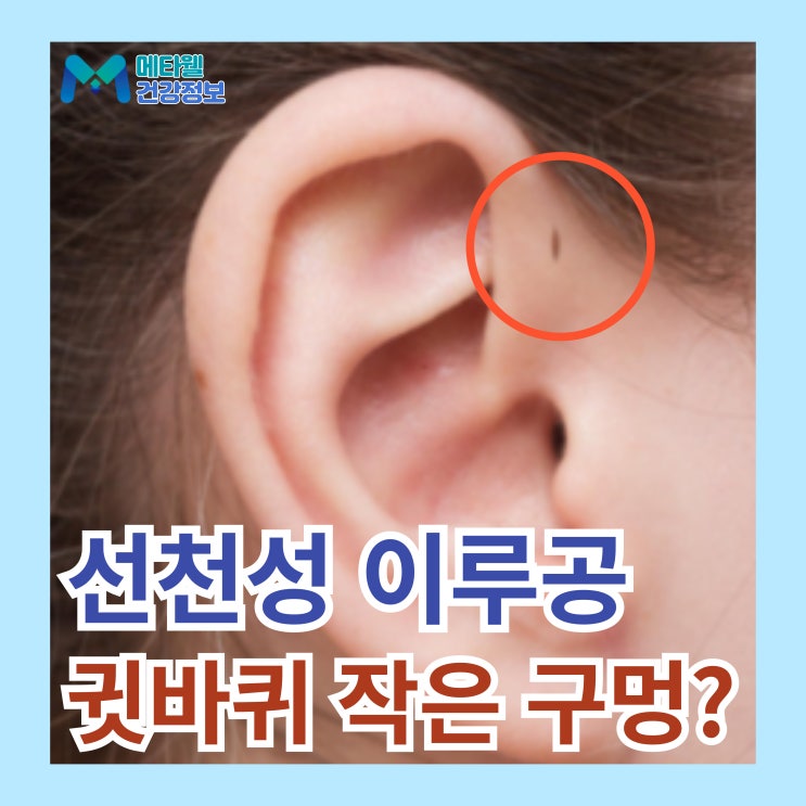  귓바퀴 옆 작은 구멍 선천성 이루공 발생 원인, 수술 꼭 해야하나요?