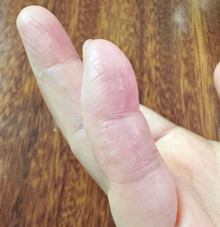  한포진 자가치료 방법, 손가락수포 관리법 - 제발 없어져라!