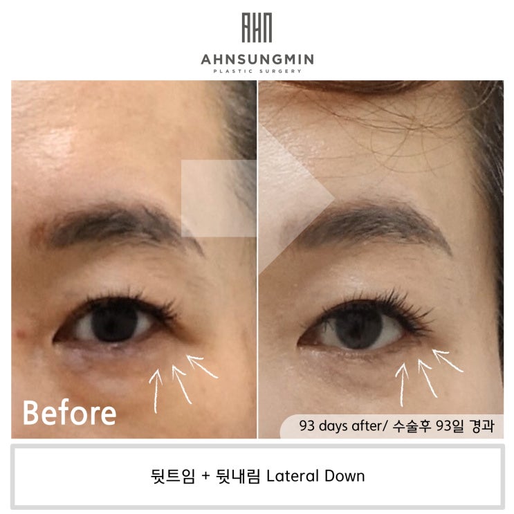  뒷트임 후 눈뜨기가 쉬워요 [성형외과 전문의 안성민]