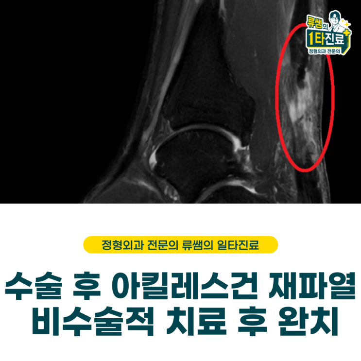  수술 후 8주째 아킬레스건 재파열, 비수술 치료로 완치(의사작성)
