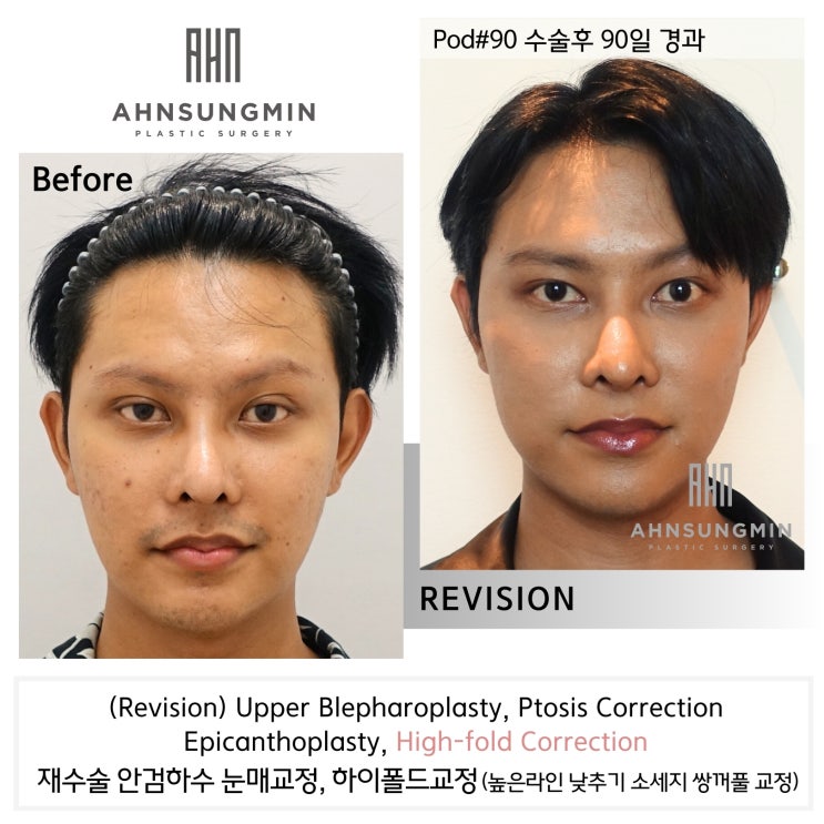  느끼한 남자 눈 무쌍이 되고 싶어요. 두꺼운 쌍꺼풀 낮추기