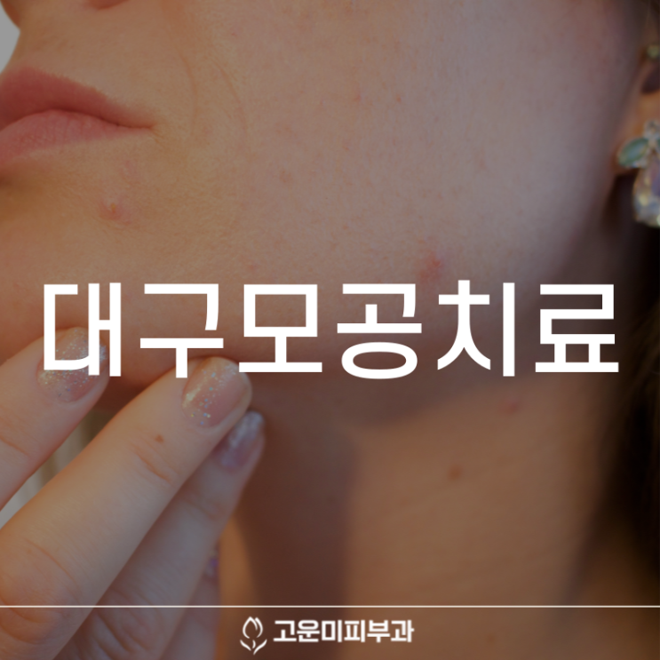  대구모공치료 피부가 오톨도톨해지는 모공각화증 치료 빠를수록 좋습니다
