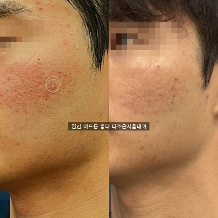  안산큐어젯  MLA 서브시전 여드름 패인흉터 피부과