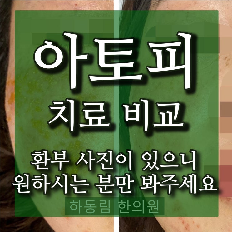  5년간의 아토피,습 관리 및 치료 호전 후기