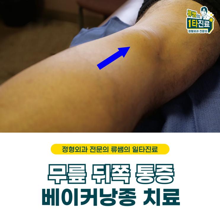  무릎 뒤쪽 통증, 베이커 낭종 치료(의사작성)