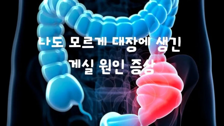  게실은 무엇? 대장 게실염 생기는 이유 증상 원인 치료